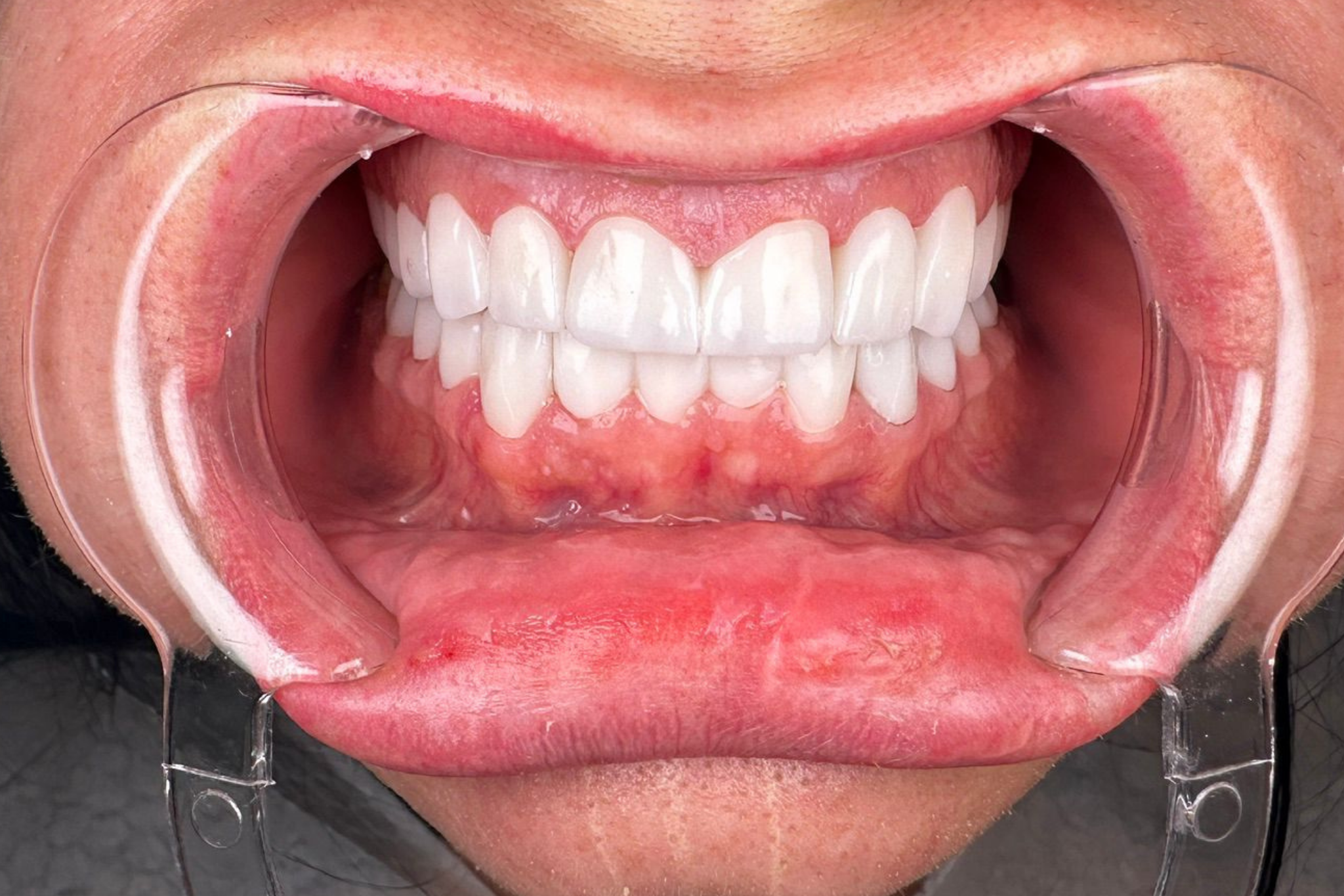 After Zirconia Crown Treatment